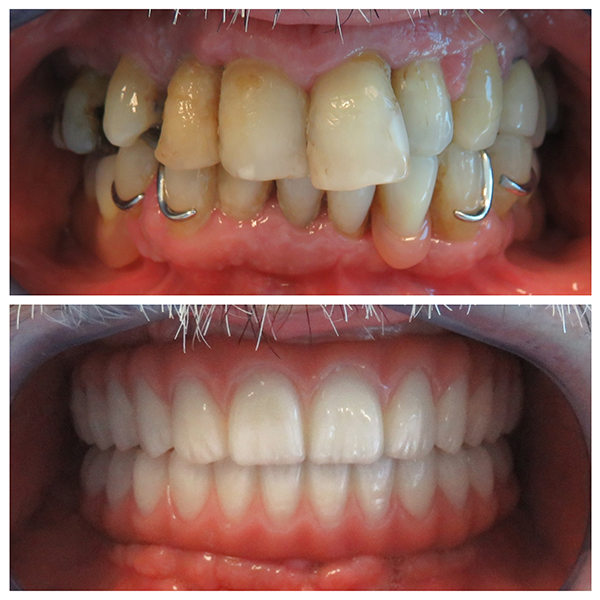 La paradentosi e denti instabili risolti con il sistema All-on-4 in combinazione con la protesi Toronto bridge