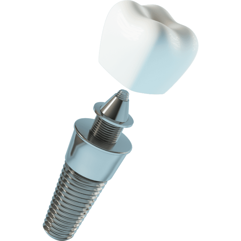 Costruzione di un impianto dentale in 3 parti; impianto, corona dentale e corona dentale